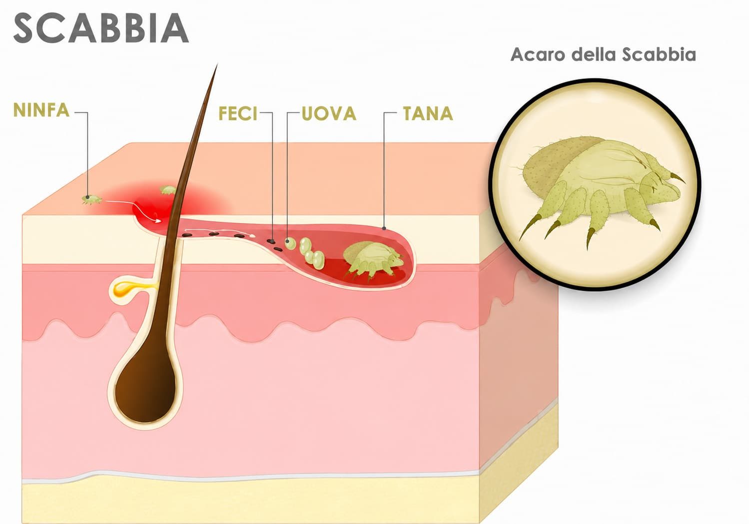 Illustrazione dell'acaro della scabbia nella pelle